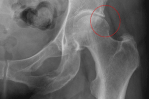 X-ray showing hip impingement