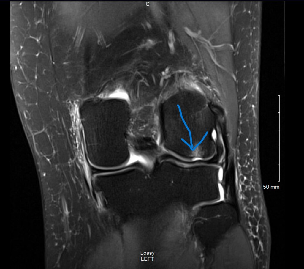 MRI image of knee with femoral chondral defect