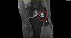MRI image of my knee a year after surgery, with the chondral defect circled in red